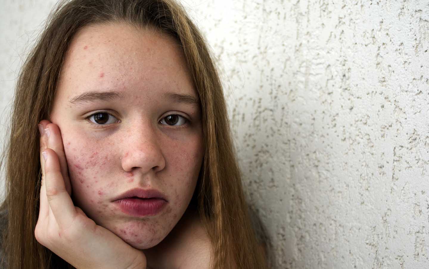 Een tiener met acne