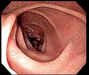 Endoscopie van een twaalfvingerige darm met coeliakie - Foto door Samir van Wikipedia