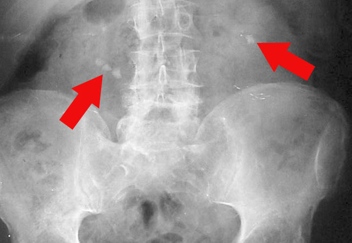 Nierstenen zichtbaar op een röntgenfoto - Bron: Flickr.com - Pijl is toegevoegd.
